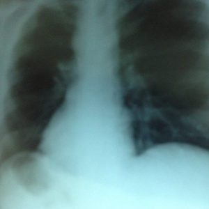 Få behandling mod kronisk bronkitis nu, og få en nemmere hverdag