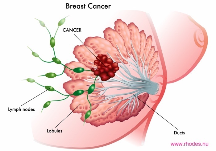 Med brystkræft får du en bio-logisk forklaring via en METAanalyse